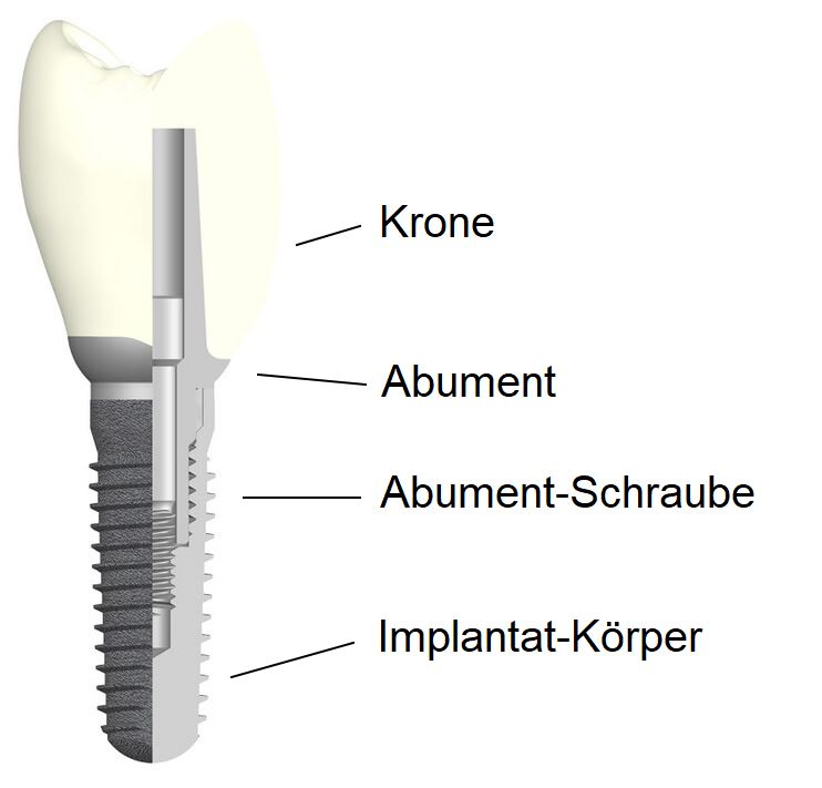 Implantat
